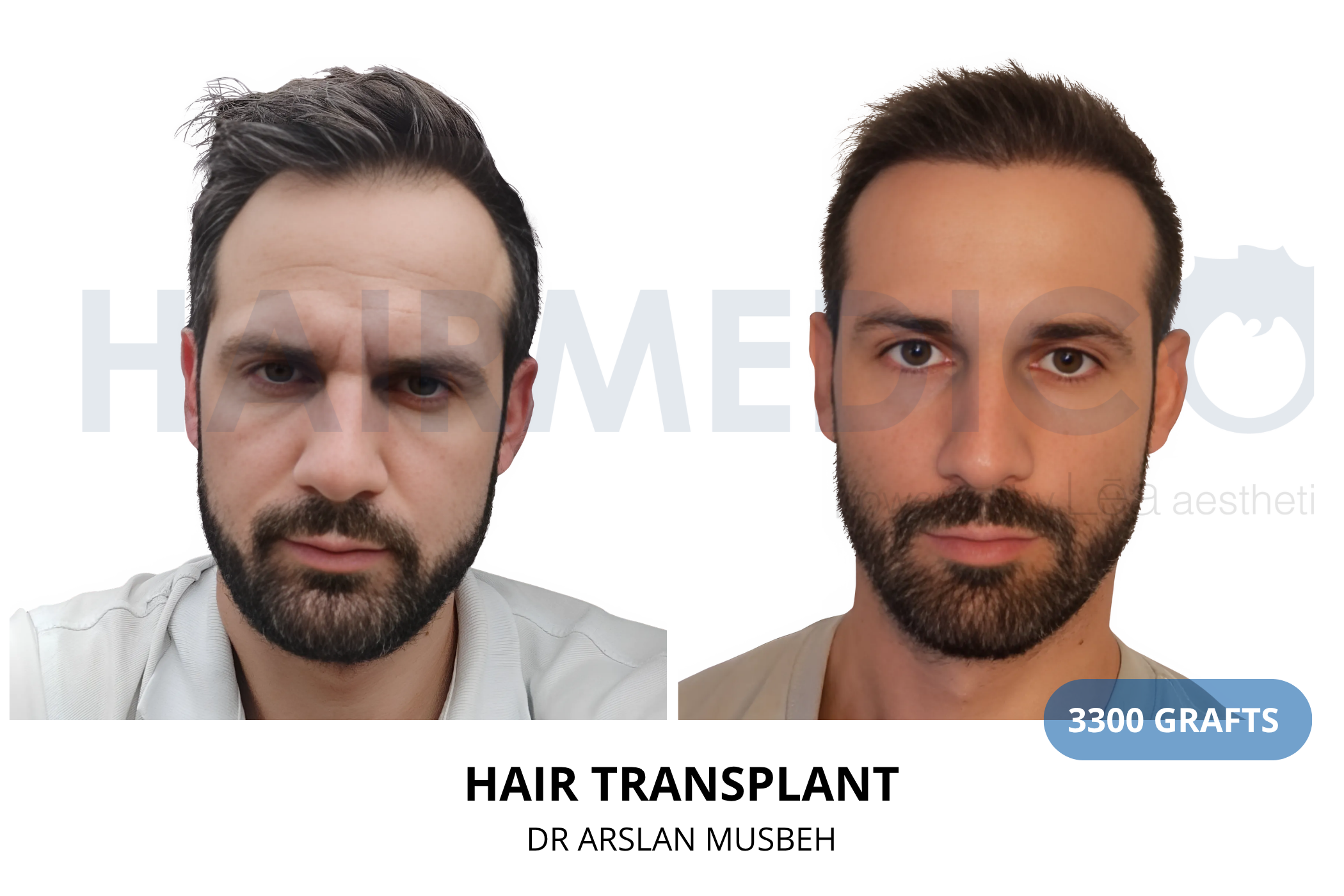 Hair transplant 12-month result — 1850 grafts DHI, Dr. Arslan Musbeh, Hairmedico Istanbul