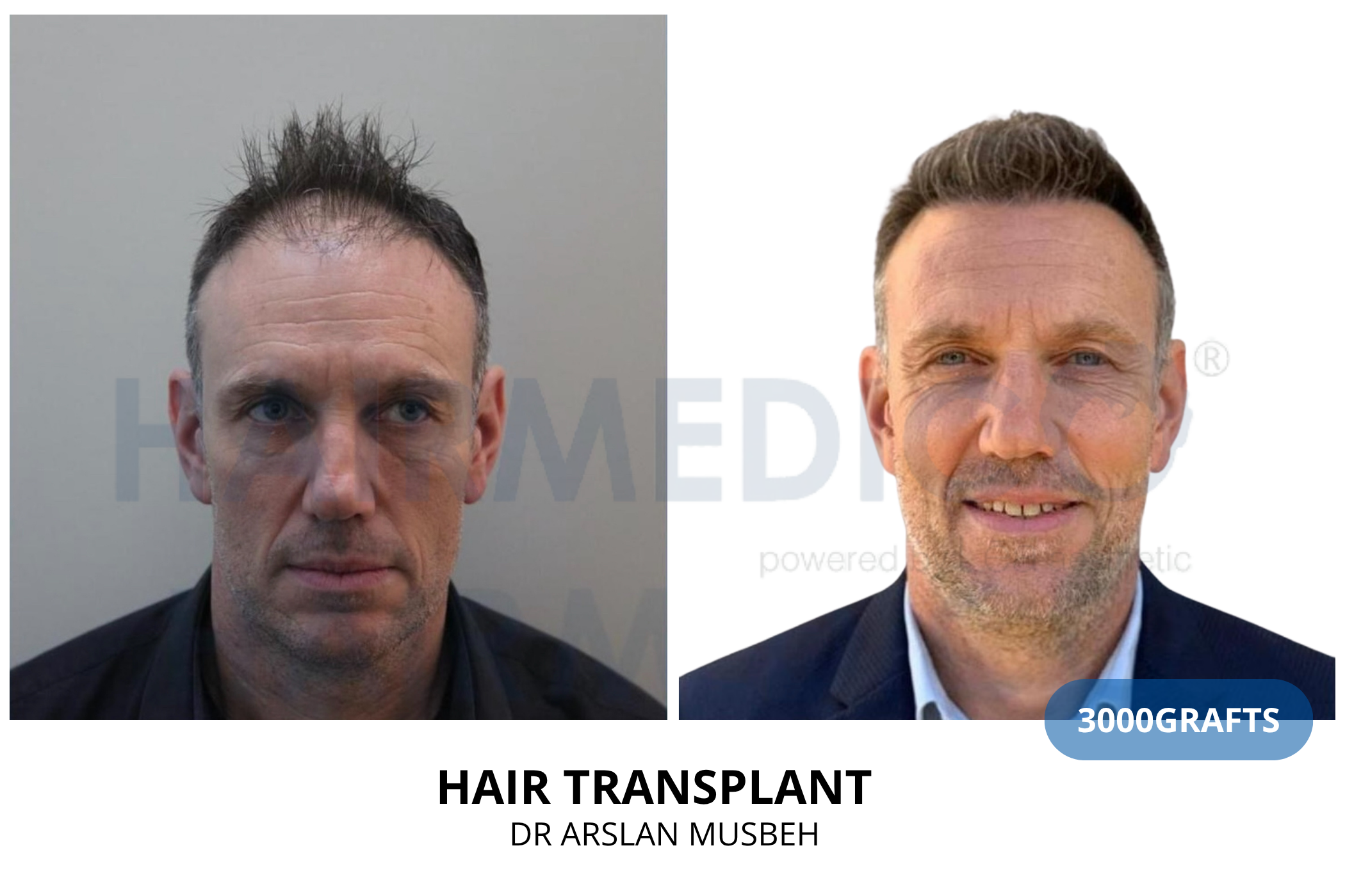 Hair transplant consultation result — 2175 grafts DHI, Dr. Arslan Musbeh, Hairmedico Istanbul