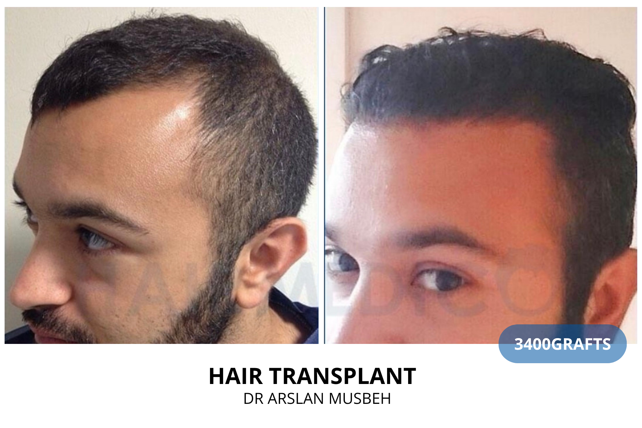 Hair transplant consultation result — 2325 grafts DHI, Dr. Arslan Musbeh, Hairmedico Istanbul