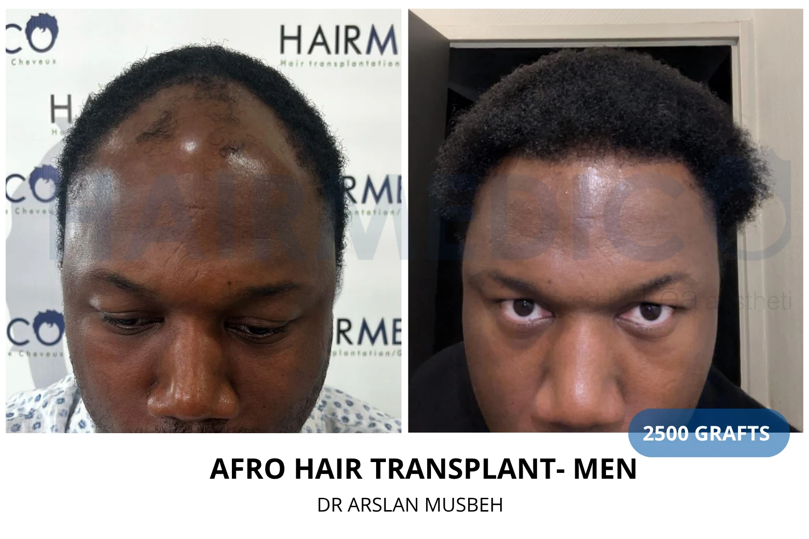 Hair transplant 2500 grafts FUE before and after at Hairmedico clinic by Dr. Arslan Musbeh in Istanbul