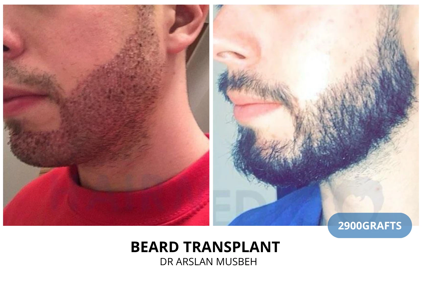 Hair transplant 2700 grafts FUE before and after at Hairmedico clinic by Dr. Arslan Musbeh in Istanbul