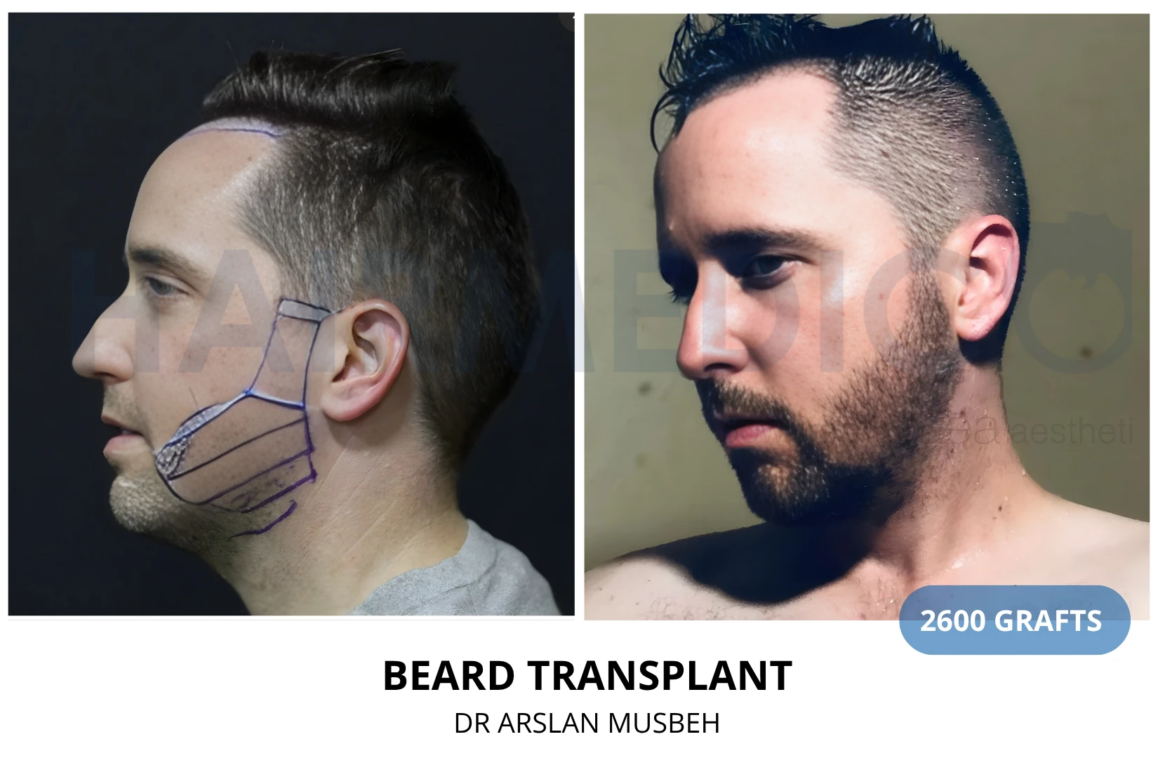 Hair transplant 3200 grafts FUE before and after at Hairmedico clinic by Dr. Arslan Musbeh in Istanbul