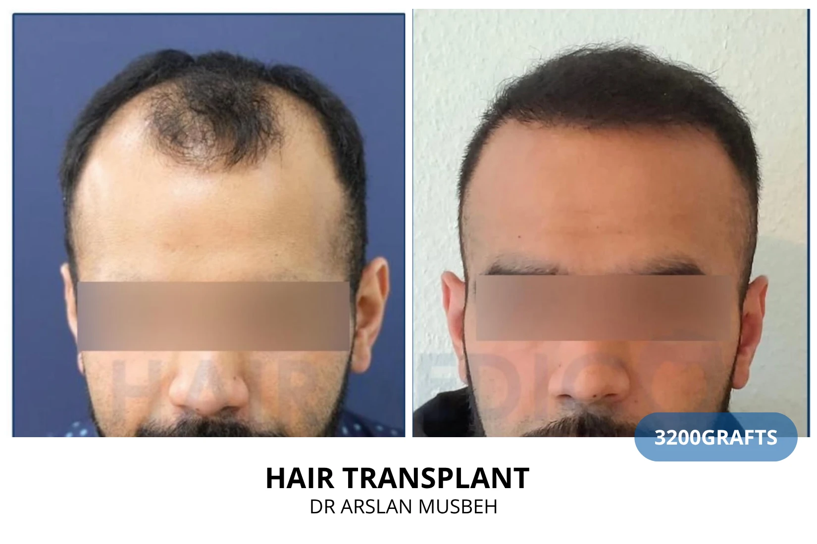 Hair transplant 2700 grafts FUE before and after at Hairmedico clinic by Dr. Arslan Musbeh in Istanbul