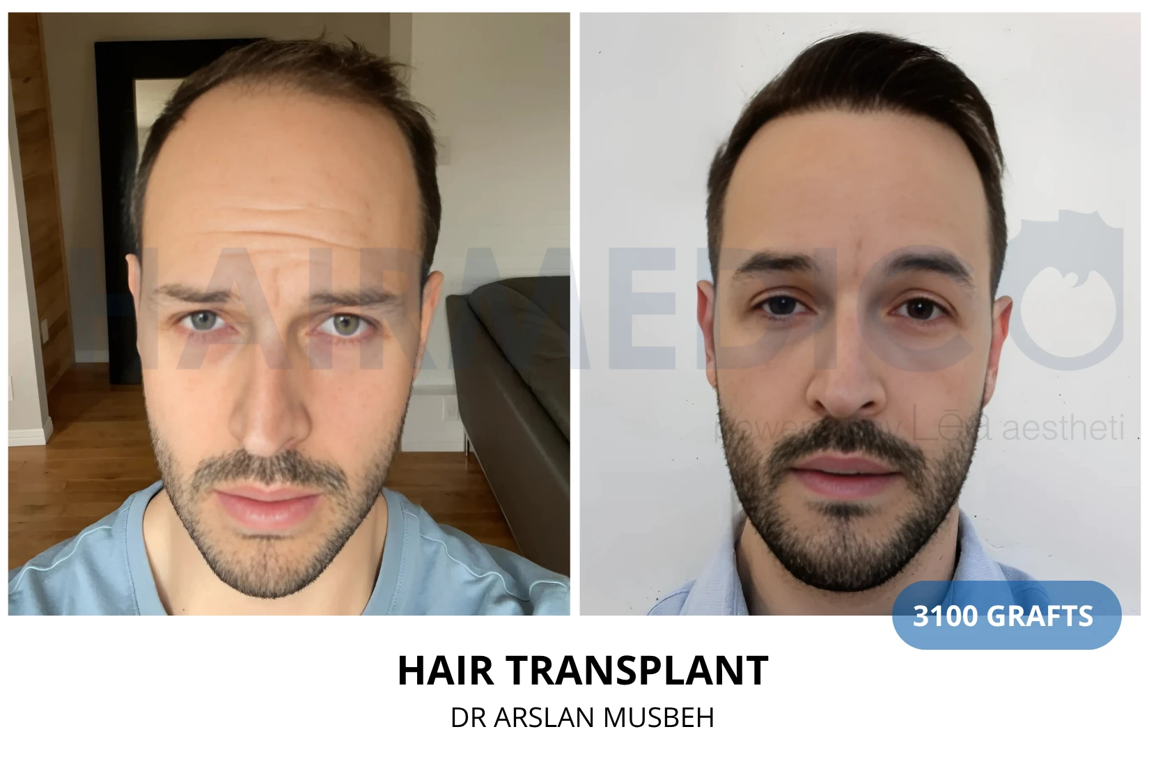 Hair transplant 3300 grafts FUE before and after at Hairmedico clinic by Dr. Arslan Musbeh in Istanbul