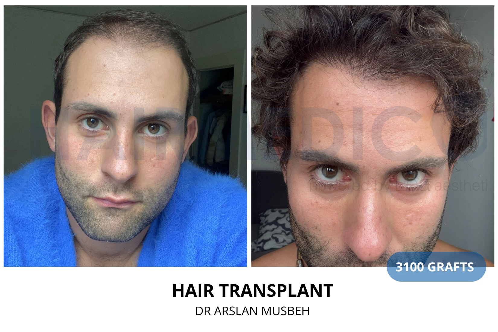 Hair transplant 3100 grafts FUE before and after at Hairmedico clinic by Dr. Arslan Musbeh in Istanbul