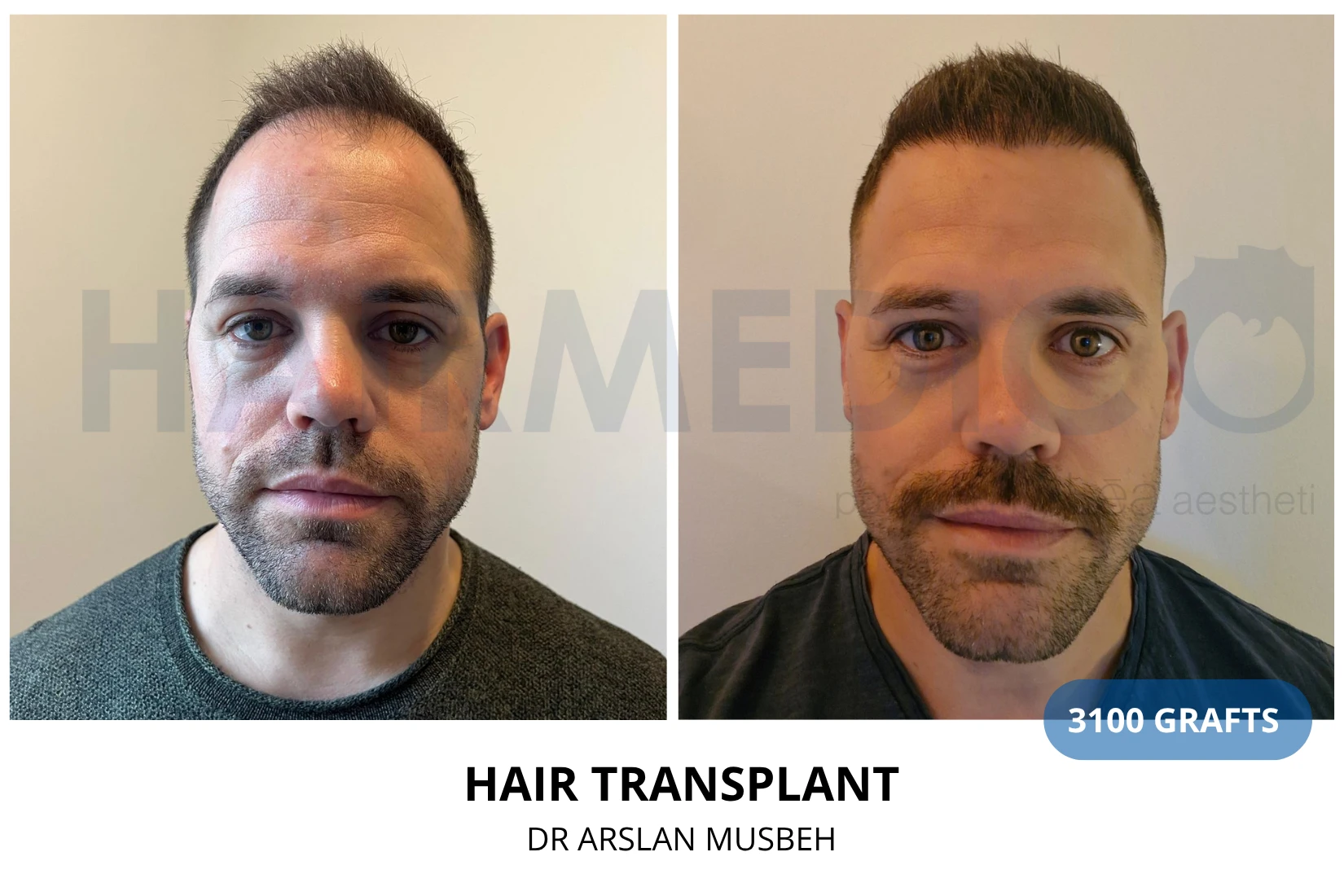 Hair transplant 3100 grafts FUE before and after at Hairmedico clinic by Dr. Arslan Musbeh in Istanbul