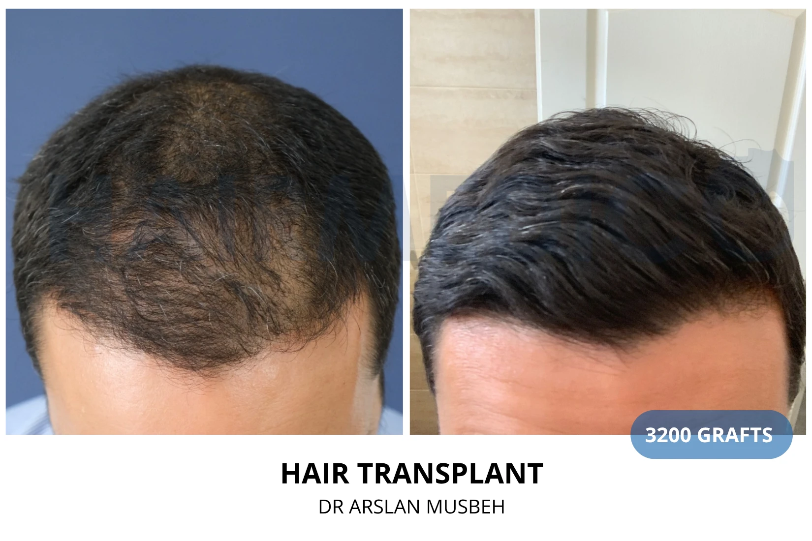 Hair transplant 3200 grafts FUE before and after at Hairmedico clinic by Dr. Arslan Musbeh in Istanbul