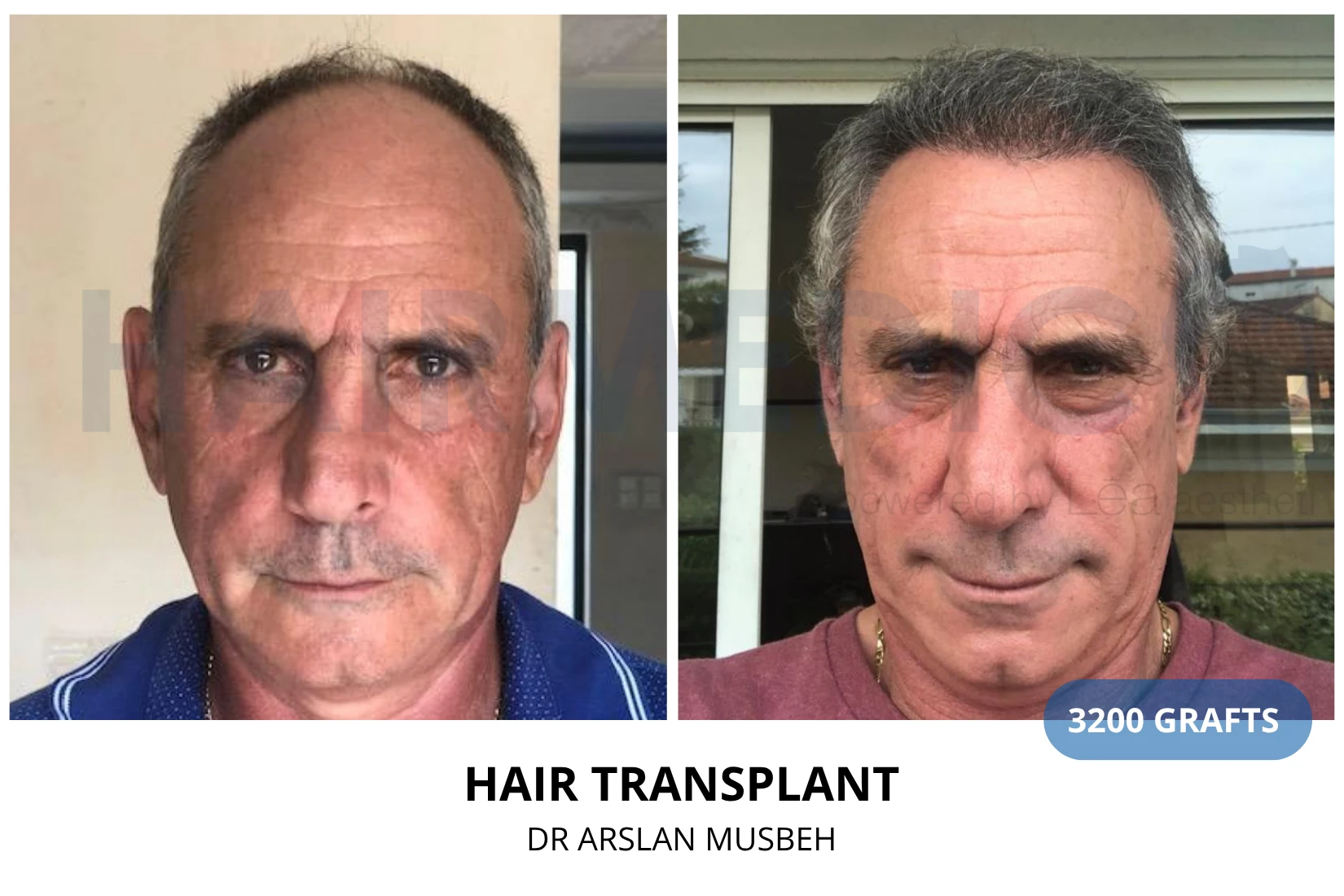 Hair transplant 3200 grafts FUE before and after at Hairmedico clinic by Dr. Arslan Musbeh in Istanbul