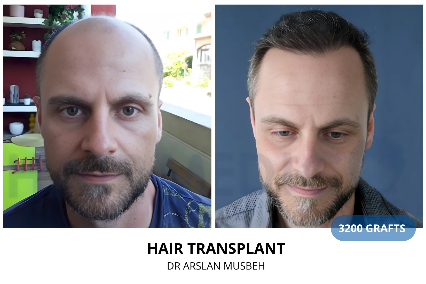 Hair transplant 3200 grafts FUE before and after at Hairmedico clinic by Dr. Arslan Musbeh in Istanbul
