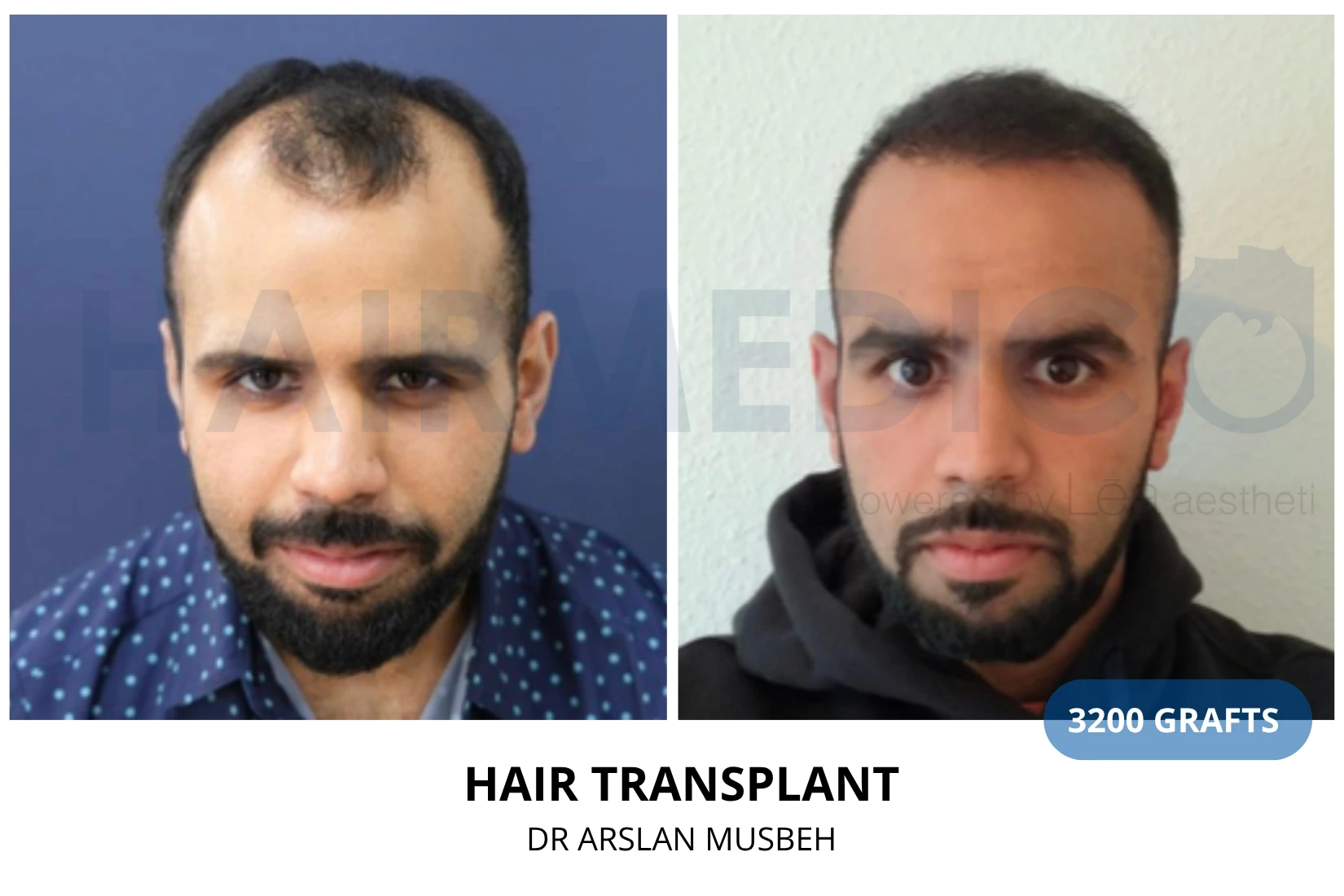 Hair transplant 3300 grafts FUE before and after at Hairmedico clinic by Dr. Arslan Musbeh in Istanbul