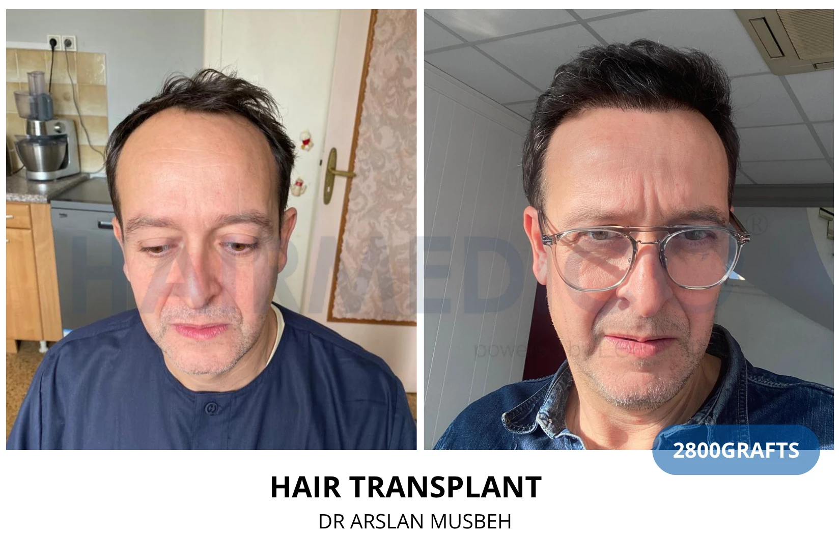 Hair transplant 2800 grafts FUE before and after at Hairmedico clinic by Dr. Arslan Musbeh in Istanbul