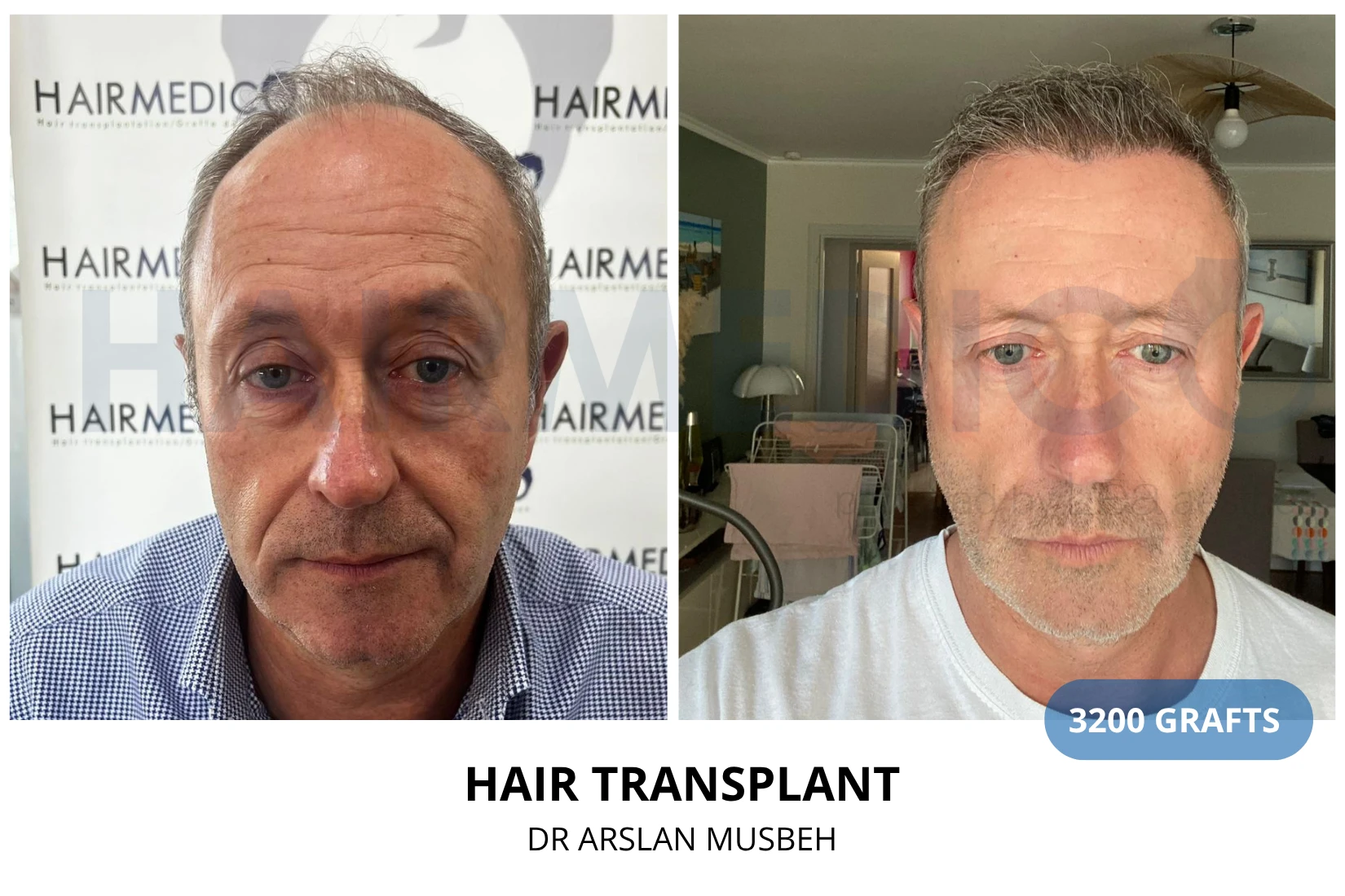 Hair transplant 2800 grafts FUE before and after at Hairmedico clinic by Dr. Arslan Musbeh in Istanbul