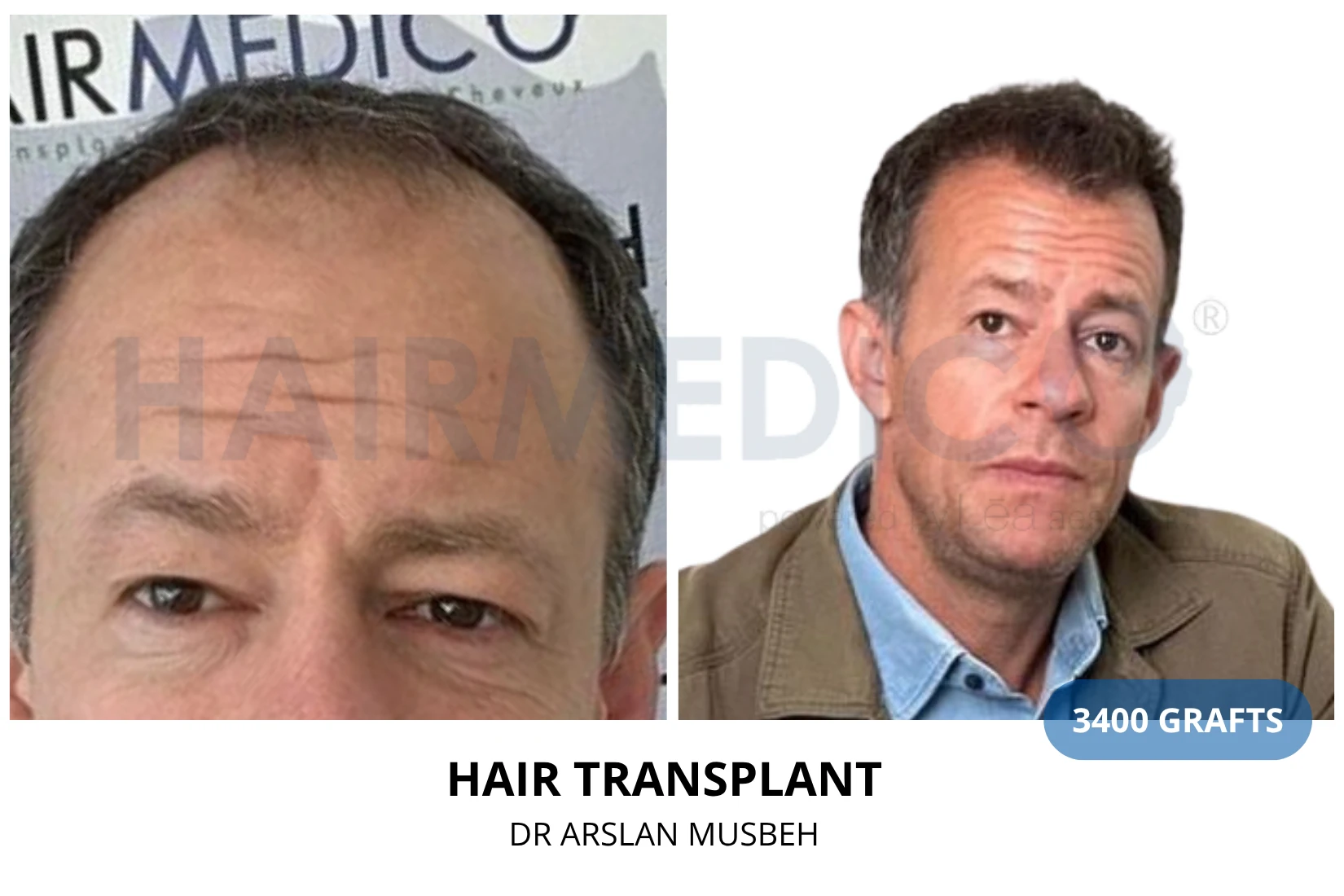 Hair transplant 3100 grafts FUE before and after at Hairmedico clinic by Dr. Arslan Musbeh in Istanbul