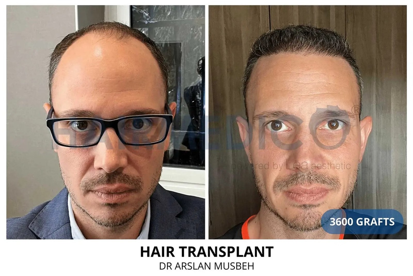 SMP scalp micropigmentation result density illusion Hairmedico