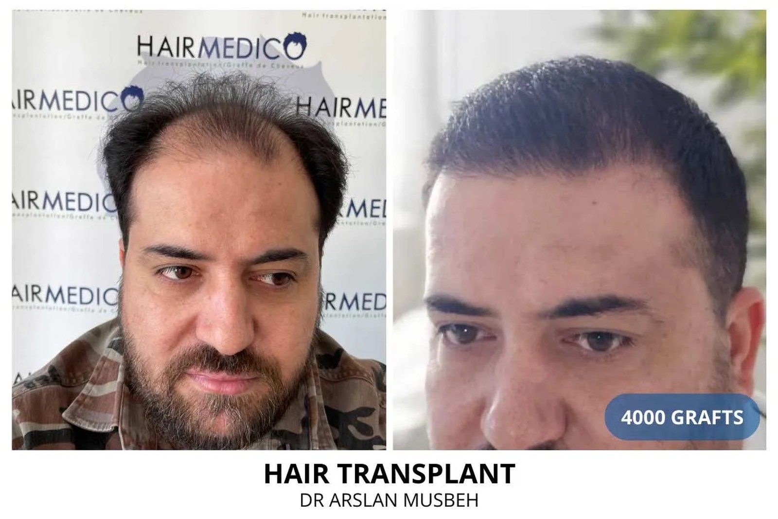 Afro hair transplant specialist FUE Istanbul Hairmedico curved follicle technique