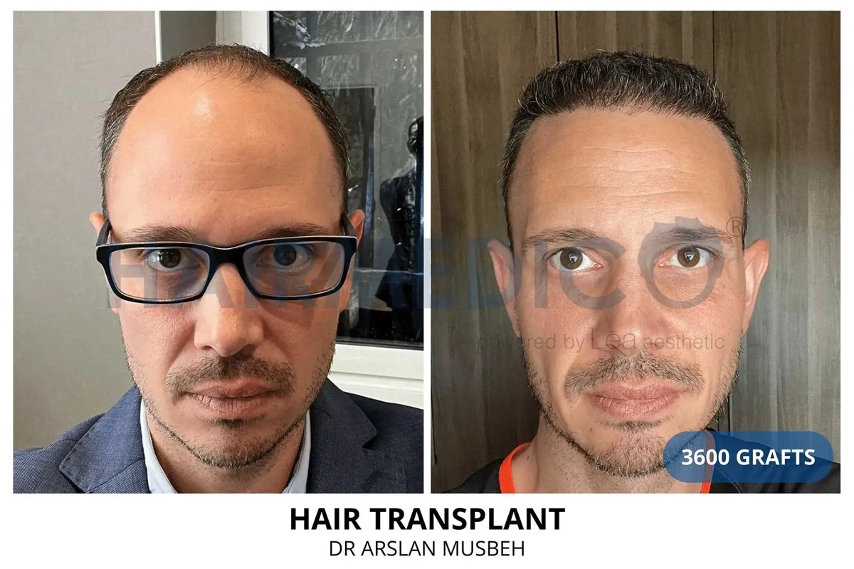 Hair transplant before and after — 3600
