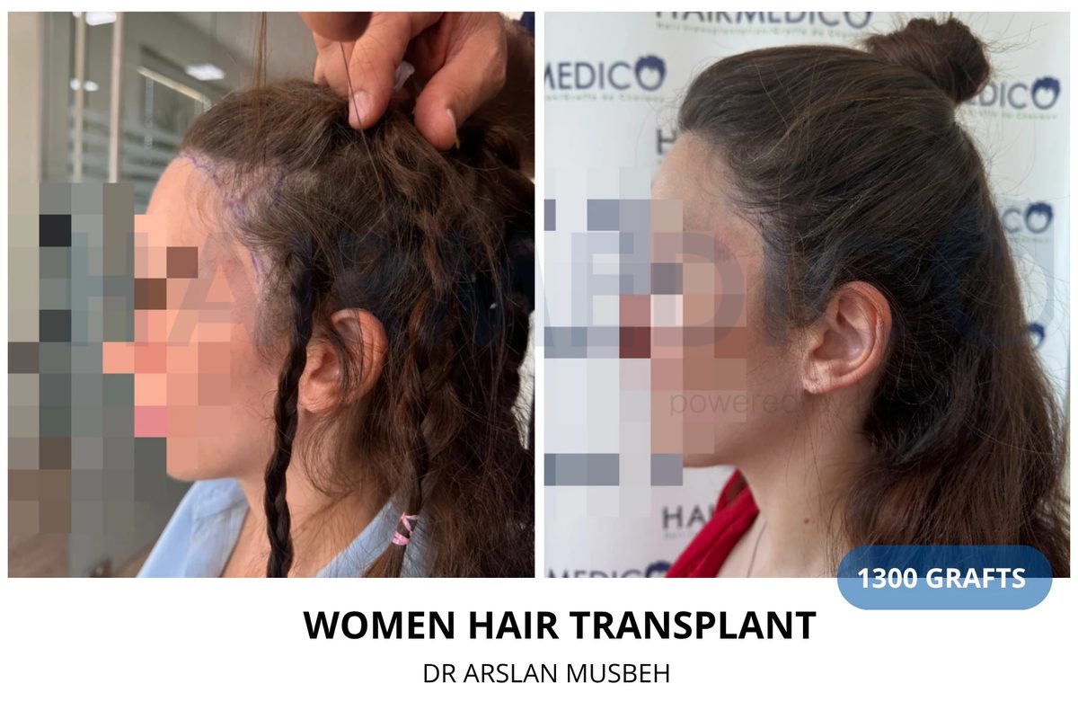 Hair transplant before and after — 3700