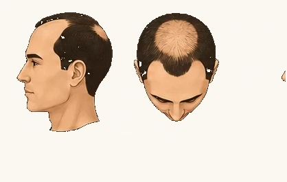 IV