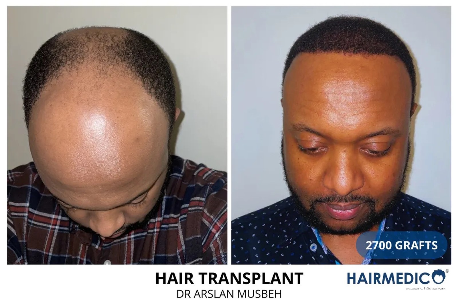 Hair transplant vs non-surgical result before after Hairmedico