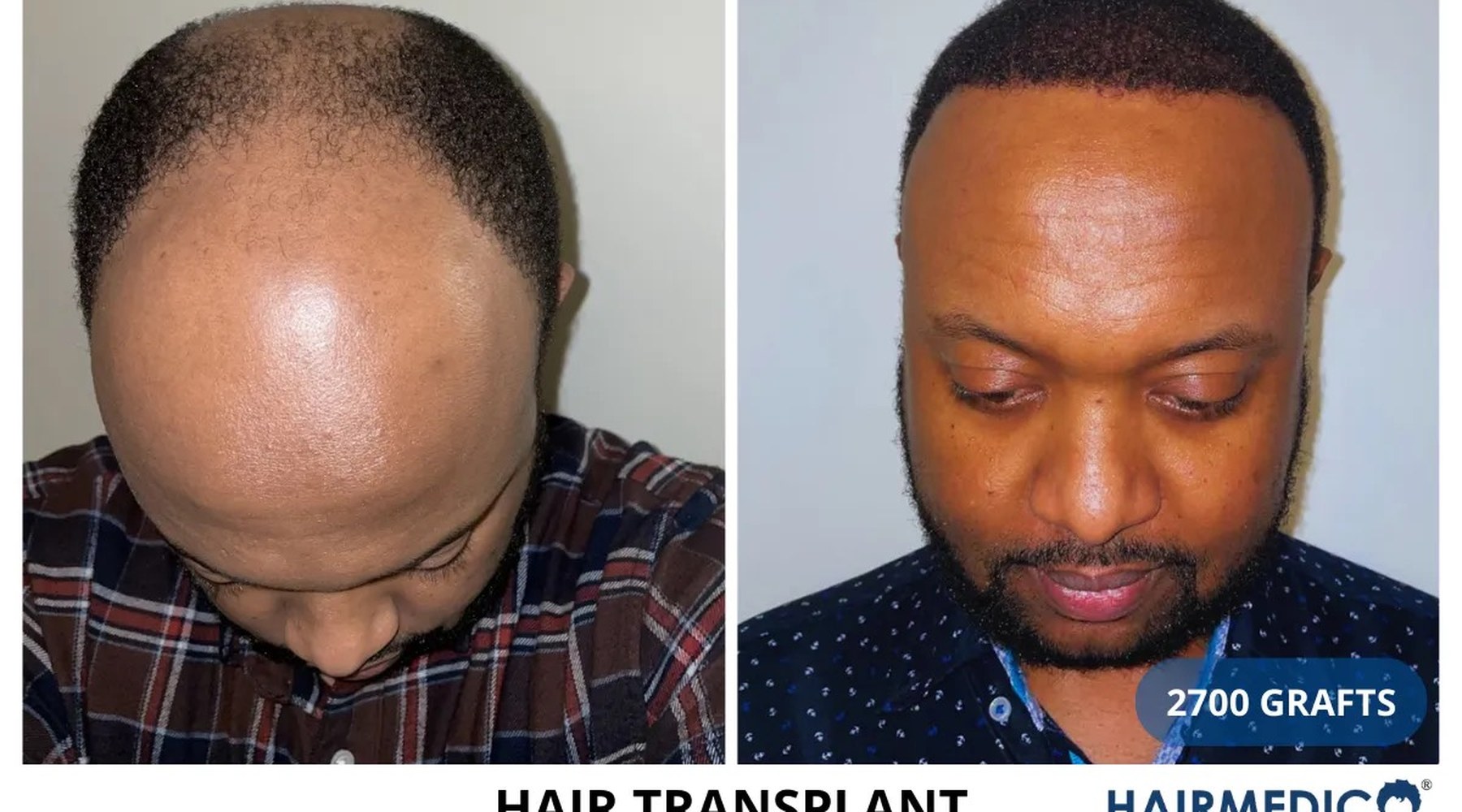 Hair transplant results — natural growth at 12 months