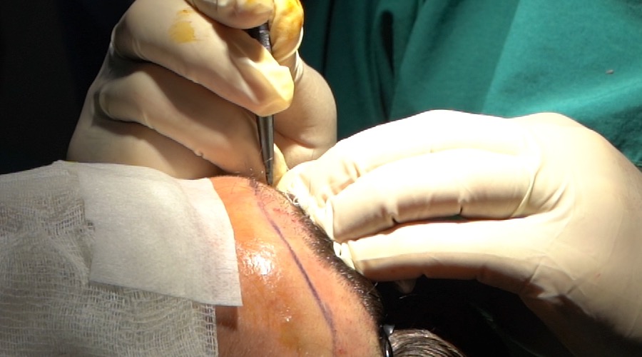 Hair transplant surgeon consultation and planning session