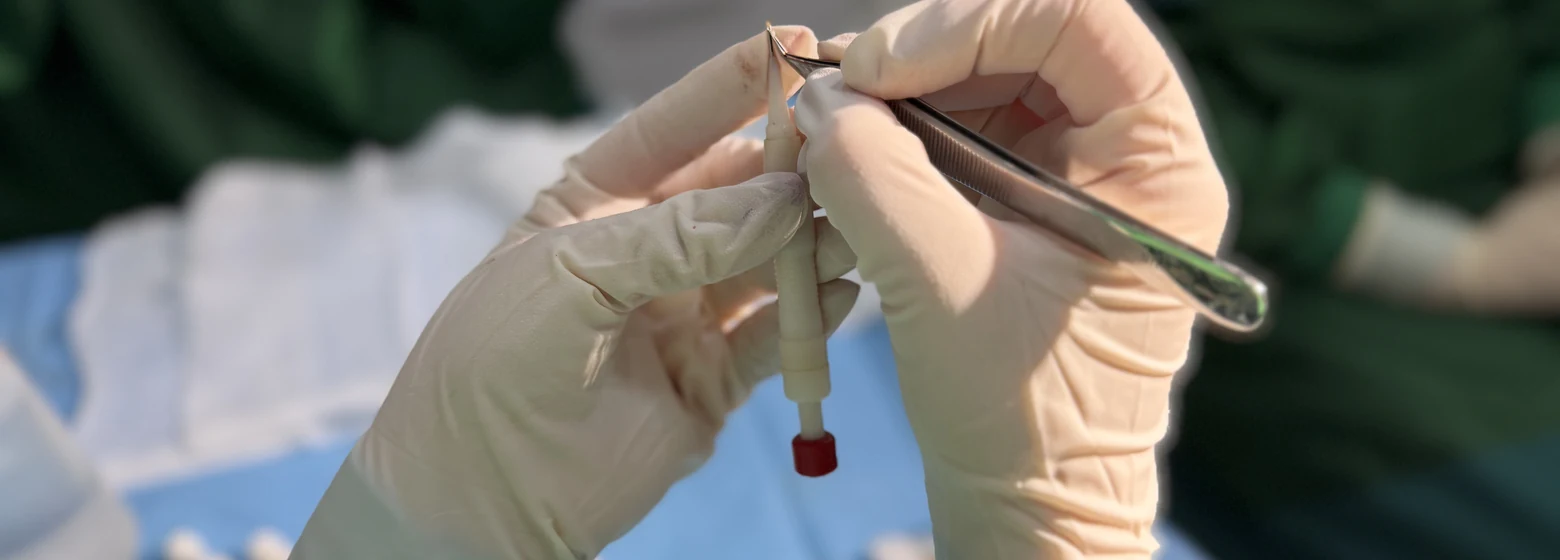 Forceps loading a follicular graft into a Choi implanter pen during DHI hair transplant