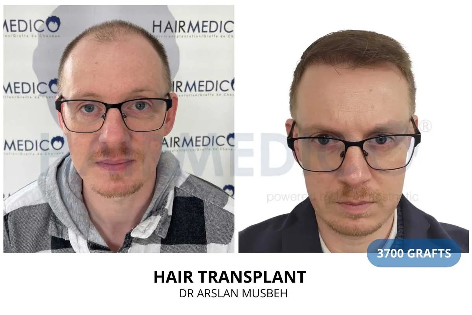 Hair transplant result Hairmedico Istanbul