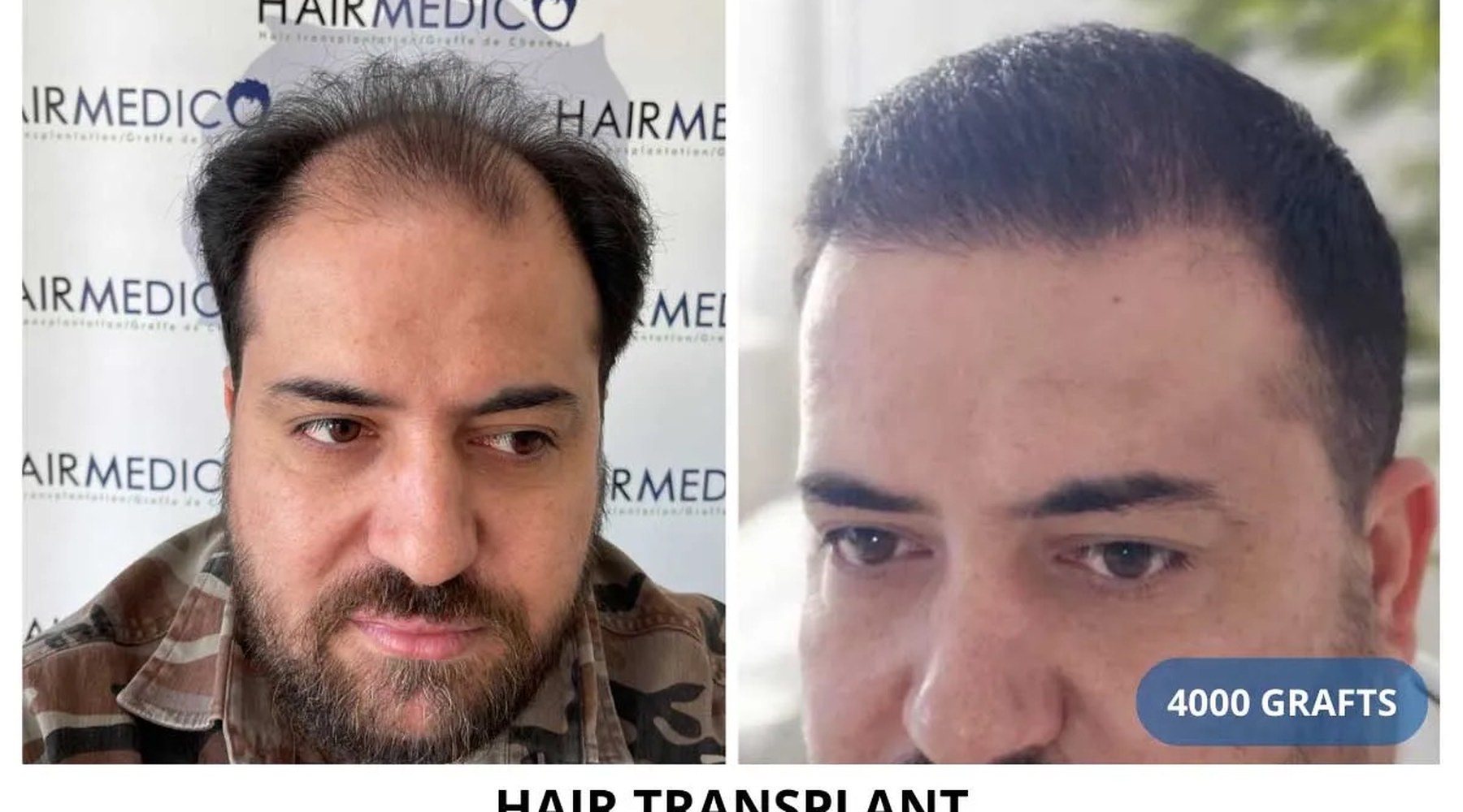 Fue Hair Transplant Complete Guide — Hairmedico Istanbul