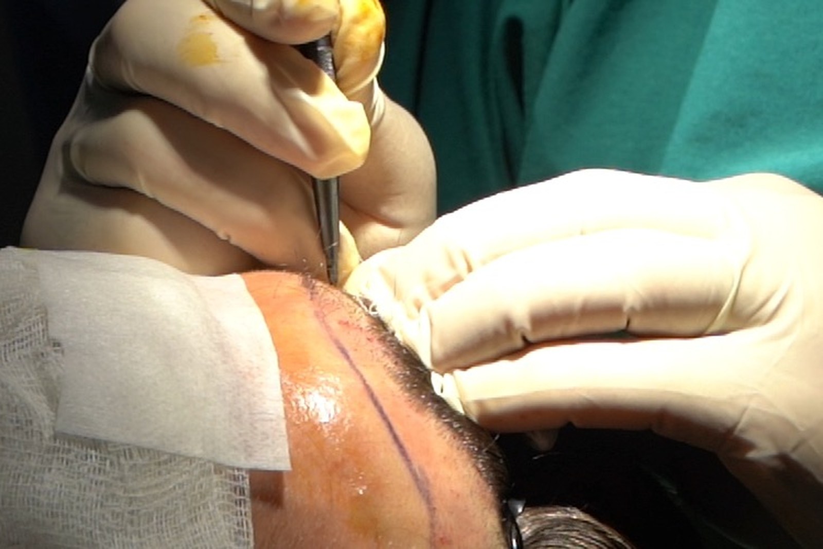 Non-surgical consultation Hairmedico Istanbul Dr Arslan