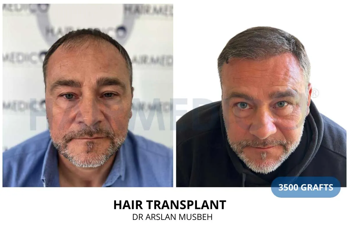 Hair transplant before and after result, 3500 grafts, documented through the Hairmedico 12-month follow-up programme