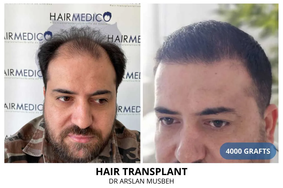 Hair transplant before and after result, 4000 grafts, Hairmedico Istanbul
